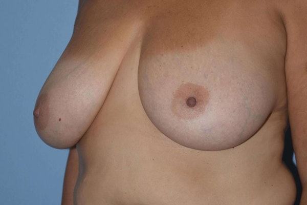 Breast Reduction Before & After Gallery - Patient 14281628 - Image 3