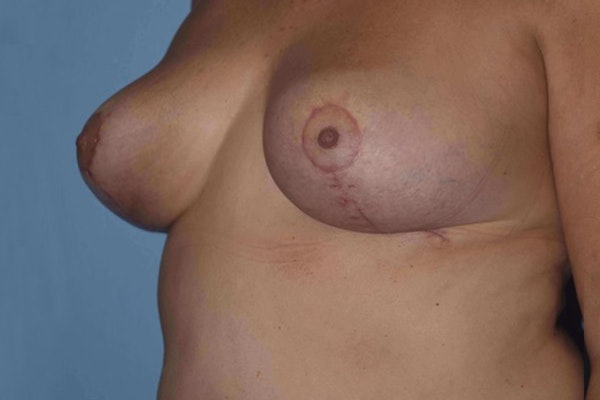 Breast Reduction Before & After Gallery - Patient 14281628 - Image 4