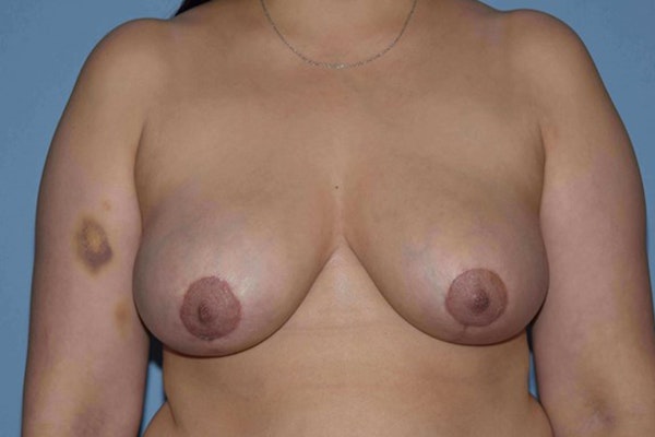 Breast Reduction Before & After Gallery - Patient 14281629 - Image 2