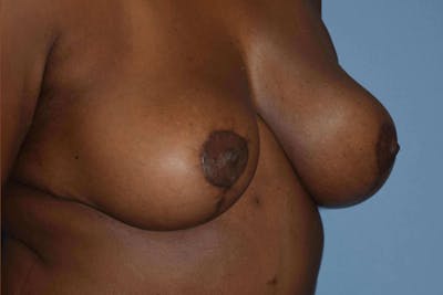 Breast Reduction Before & After Gallery - Patient 14281641 - Image 4