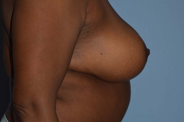 Breast Reduction Before & After Gallery - Patient 14281641 - Image 6