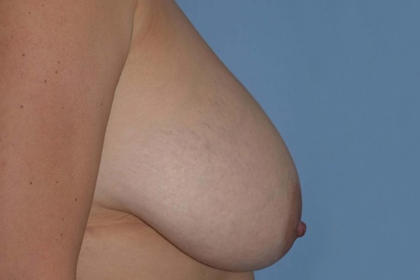 Breast Reduction Before & After Gallery - Patient 14281653 - Image 5