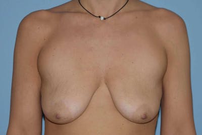 Breast Augmentation Lift Before & After Gallery - Patient 14281682 - Image 1