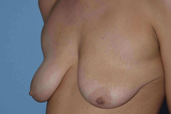Breast Augmentation Lift Before & After Gallery - Patient 14281682 - Image 3