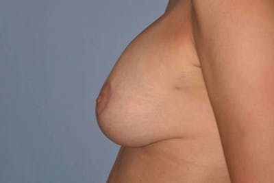 Breast Augmentation Lift Before & After Gallery - Patient 14281682 - Image 6
