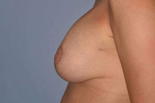 Breast Augmentation Lift Before & After Gallery - Patient 14281682 - Image 6