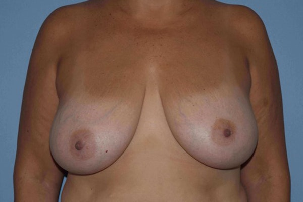 Breast Lift Before & After Gallery - Patient 14281688 - Image 1