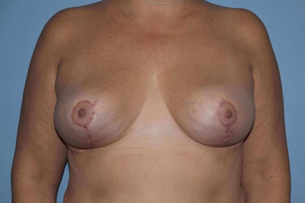 Breast Lift Gallery - Patient 14281688 - Image 2