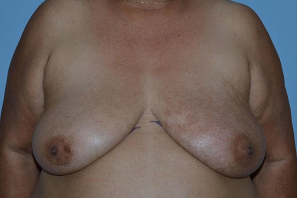 Breast Reconstruction Before & After Gallery - Patient 14281732 - Image 5