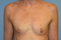 Breast Reconstruction Before & After Gallery - Patient 14281734 - Image 1