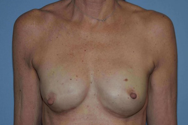 Breast Reconstruction Before & After Gallery - Patient 14281734 - Image 2