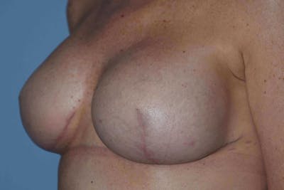Breast Reconstruction Before & After Gallery - Patient 14281735 - Image 8