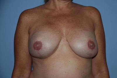 Breast Reconstruction Before & After Gallery - Patient 14281735 - Image 10