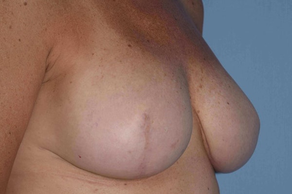 Breast Reconstruction Before & After Gallery - Patient 14281735 - Image 11
