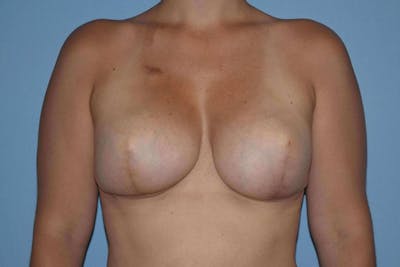 Breast Reconstruction Before & After Gallery - Patient 14281736 - Image 2