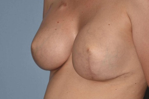 Breast Reconstruction Before & After Gallery - Patient 14281736 - Image 4