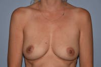 Breast Reconstruction Before & After Gallery - Patient 14281737 - Image 1