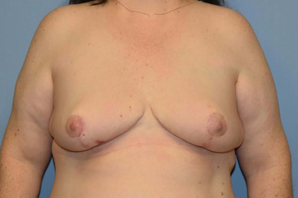 Breast Reconstruction Before & After Gallery - Patient 14281738 - Image 2