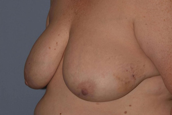 Breast Reconstruction Before & After Gallery - Patient 14281738 - Image 3