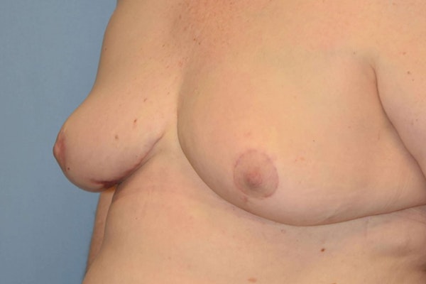 Breast Reconstruction Before & After Gallery - Patient 14281738 - Image 4