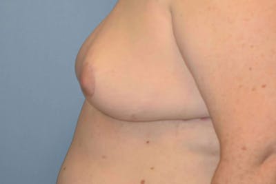 Breast Reconstruction Before & After Gallery - Patient 14281738 - Image 6