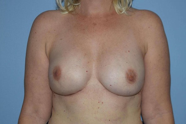 Breast Reconstruction Before & After Gallery - Patient 14281740 - Image 2
