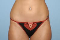 Liposuction Before & After Gallery - Patient 6389641 - Image 1