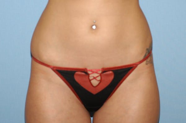 Liposuction Gallery - Patient 6389641 - Image 1