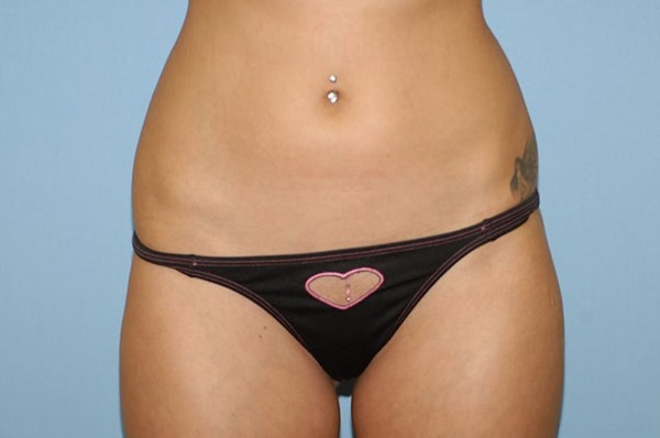 Liposuction Before & After Gallery - Patient 6389641 - Image 2