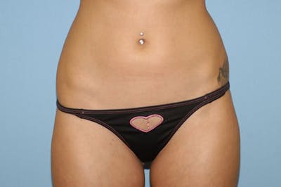 Liposuction Before & After Gallery - Patient 6389641 - Image 2