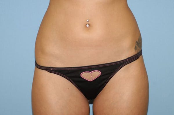 Liposuction Gallery - Patient 6389641 - Image 2