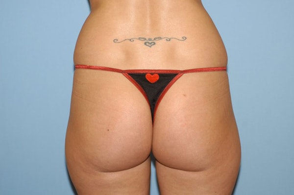 Liposuction Before & After Gallery - Patient 6389641 - Image 3