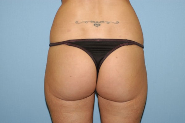 Liposuction Before & After Gallery - Patient 6389641 - Image 4