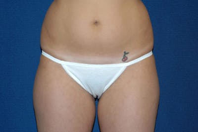 Liposuction Gallery - Patient 6389642 - Image 1