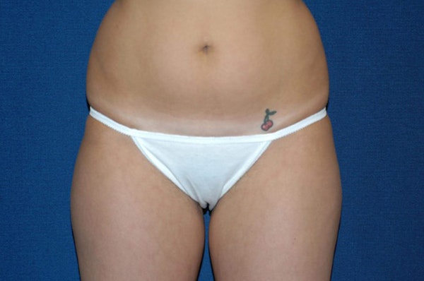 Liposuction Before & After Gallery - Patient 6389642 - Image 1