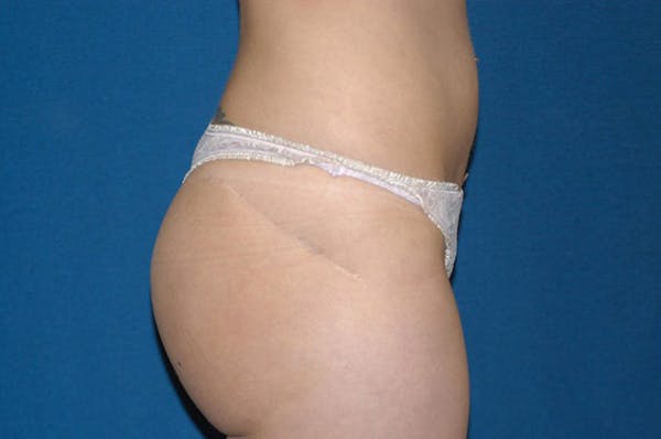 Liposuction Gallery - Patient 6389642 - Image 4
