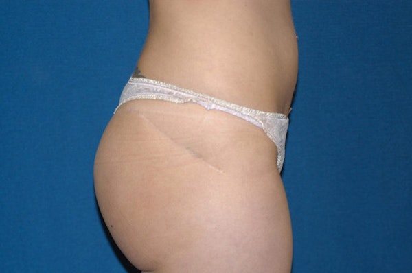 Liposuction Before & After Gallery - Patient 6389642 - Image 4