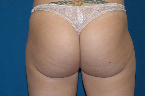 Liposuction Gallery - Patient 6389642 - Image 6