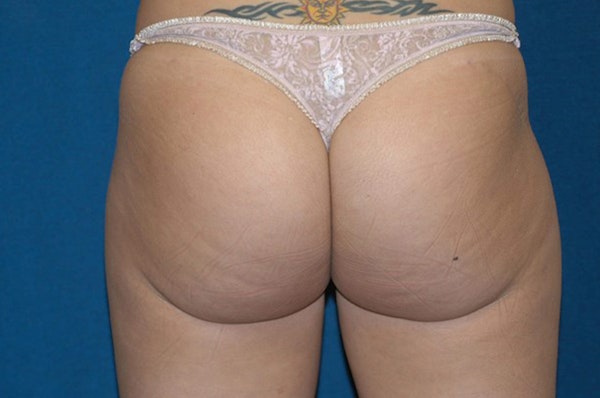 Liposuction Before & After Gallery - Patient 6389642 - Image 6