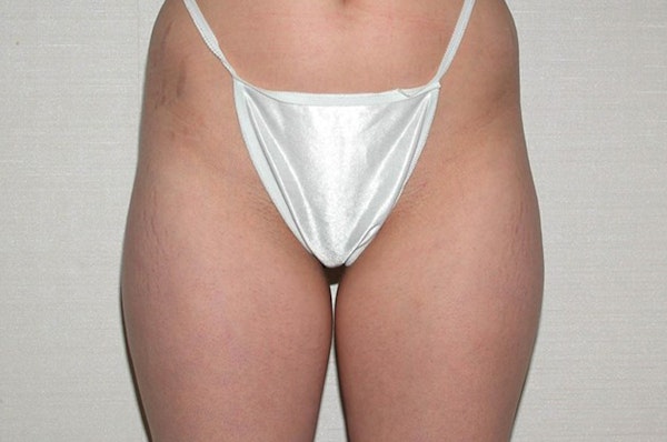 Liposuction Before & After Gallery - Patient 6389644 - Image 1