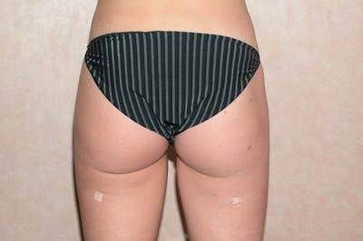 Liposuction Before & After Gallery - Patient 6389644 - Image 4