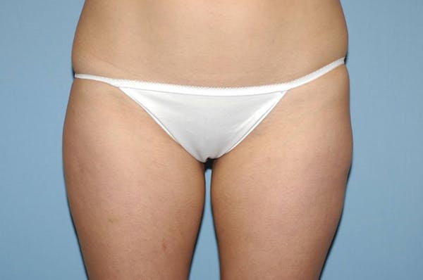 Liposuction Gallery - Patient 6389648 - Image 3