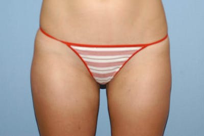 Liposuction Gallery - Patient 6389648 - Image 4
