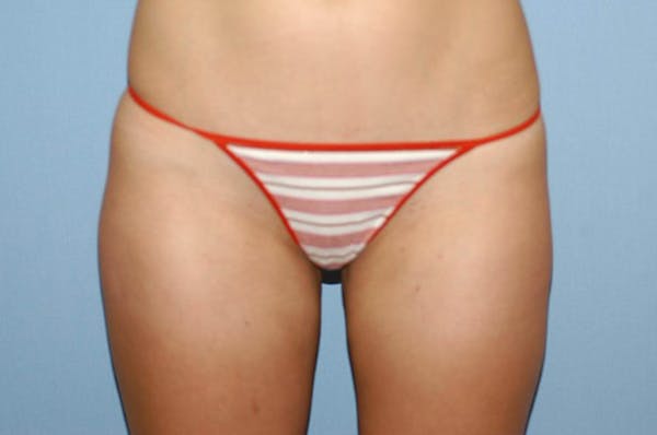 Liposuction Gallery - Patient 6389648 - Image 4