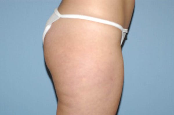 Liposuction Gallery - Patient 6389648 - Image 5