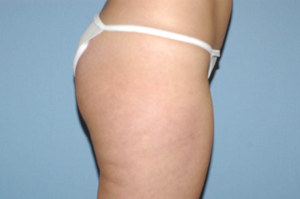 Liposuction Before & After Gallery - Patient 6389648 - Image 5