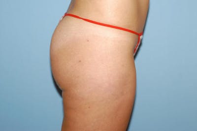 Liposuction Before & After Gallery - Patient 6389648 - Image 6