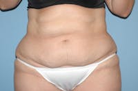 Liposuction Before & After Gallery - Patient 6389651 - Image 1