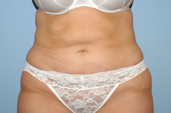 Liposuction Before & After Gallery - Patient 6389651 - Image 2