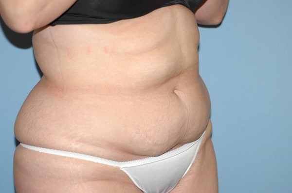 Liposuction Before & After Gallery - Patient 6389651 - Image 3